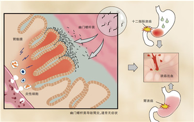 质子泵抑制剂